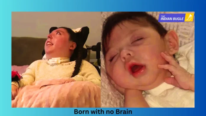Alex Simpson from Nebraska, born with a rare brain condition called hydranencephaly,