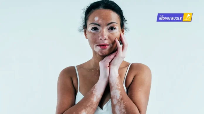 Does Eating Dairy with Salt Cause Vitiligo?